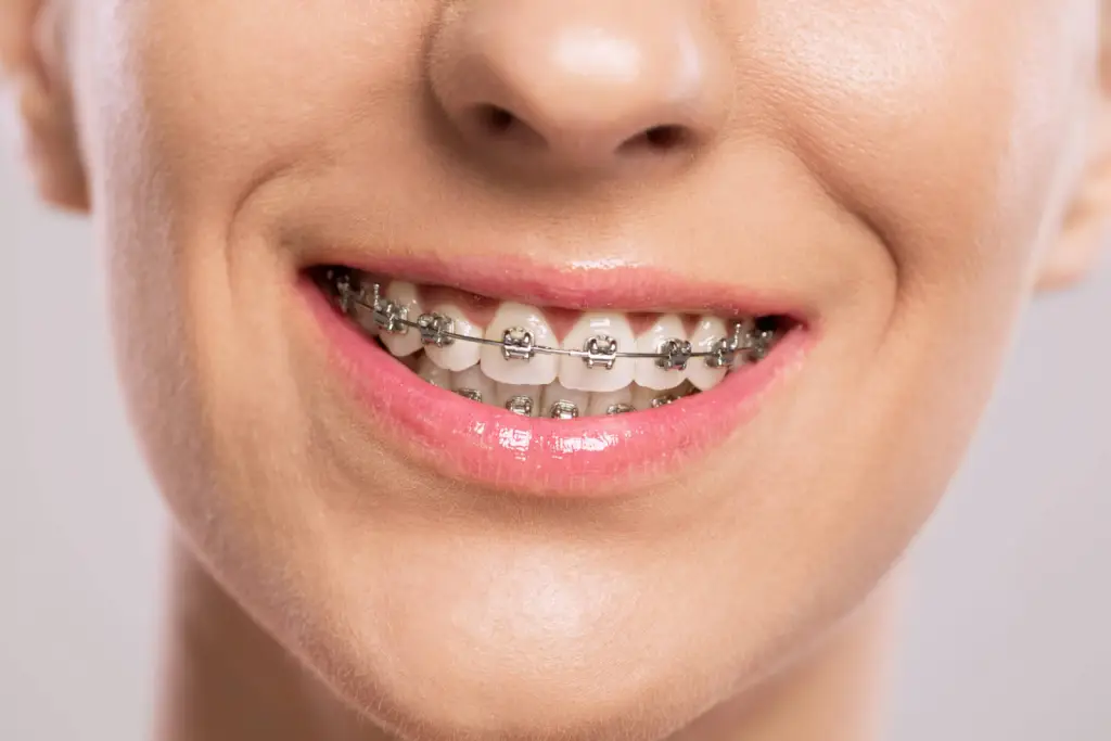 Braces For Adults