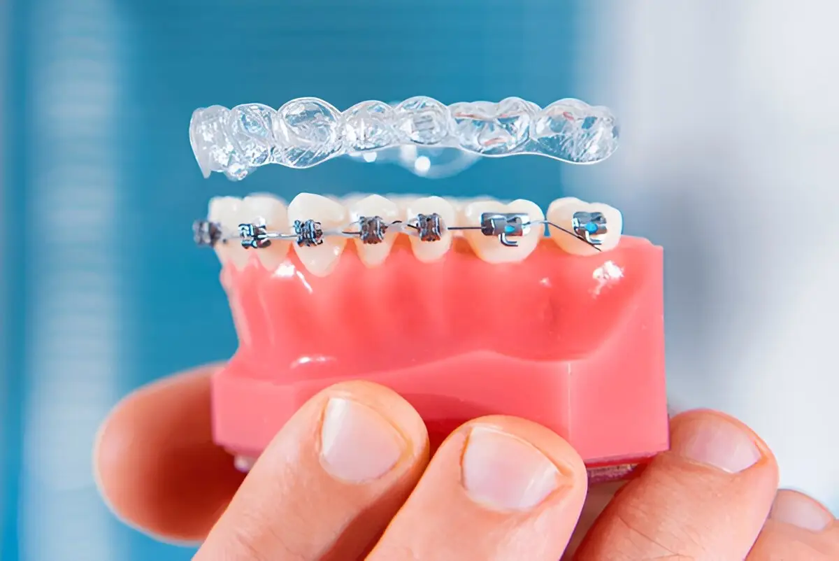 clear braces