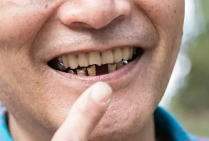 Can I Drink Coffee with Invisalign?
