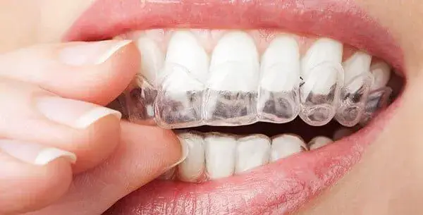 Invisalign Retainers