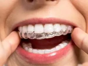 Invisalign Treatment