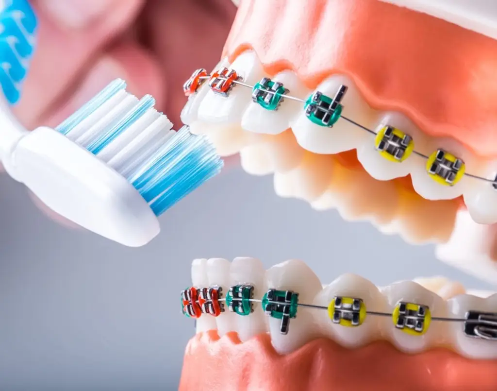 Brushing teeth while wearing braces