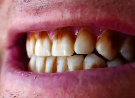 Risks of Drinking Coffee with Invisalign