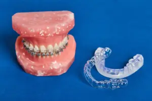 Invisalign vs Braces