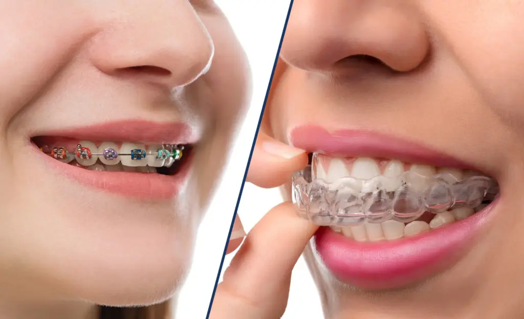 Choosing Between Braces vs Invisalign