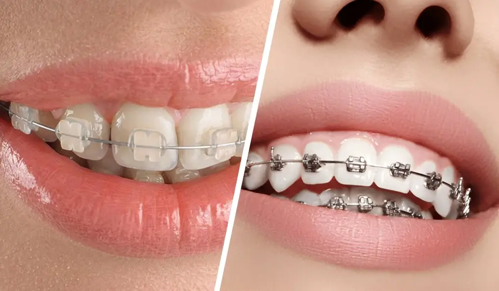 Clear Braces vs. Metal Braces: Which Option Is Right for You?