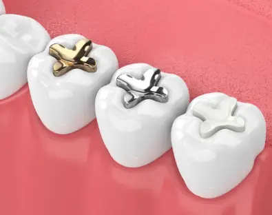 Do Dentists Still Use Silver Fillings?