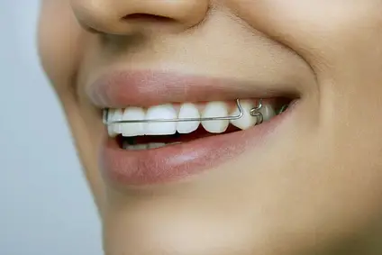 Invisalign Retainers last