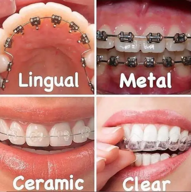 Different Types of Braces