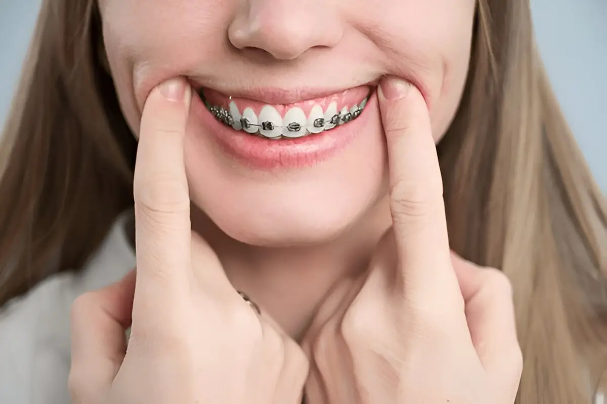 Metal Braces