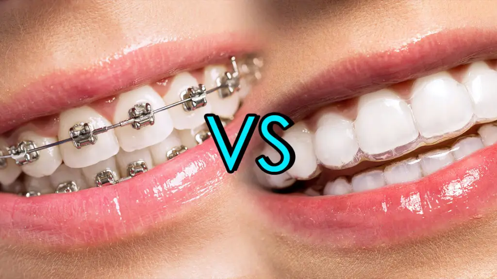 Braces and Invisalign Comparision