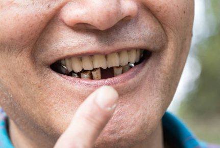 Can I Drink Coffee with Invisalign?
