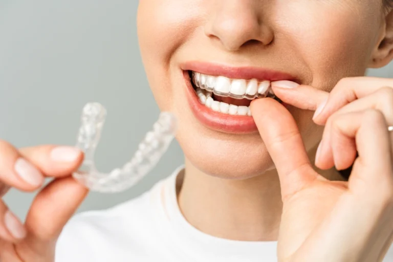 How Does Invisalign Work: Facts To Know About Invisible Braces
