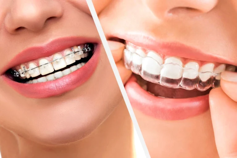 Braces vs Invisalign: Which One Is Better For Teeth Straightening 