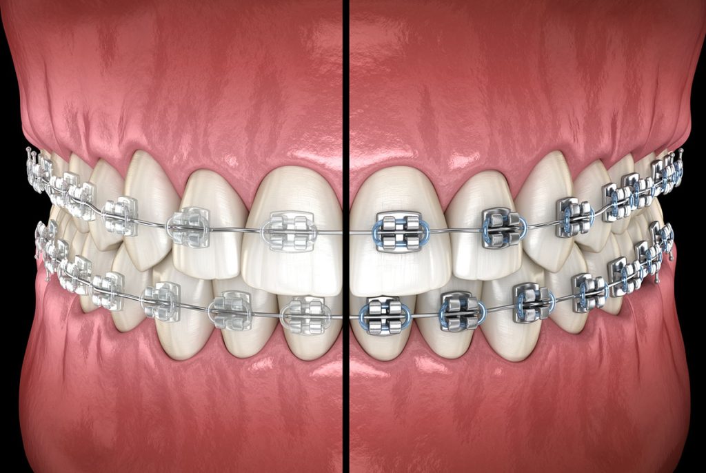 do clear braces stain