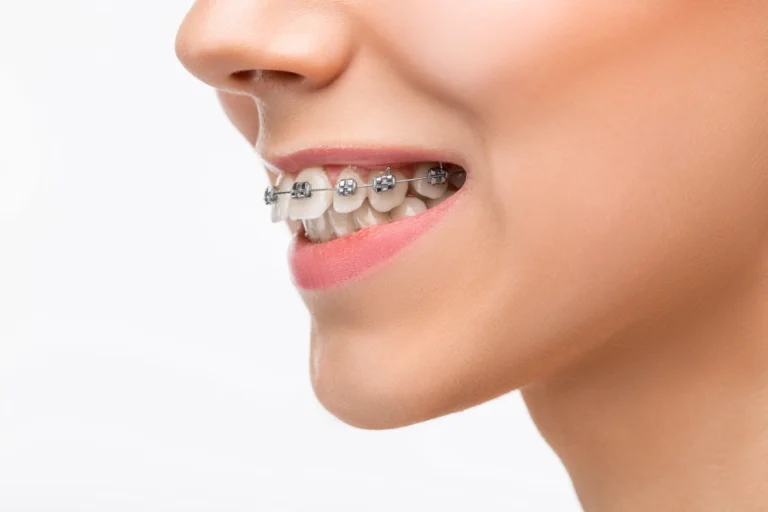 Do I Need Invisalign Forever? What to Know About Retainers