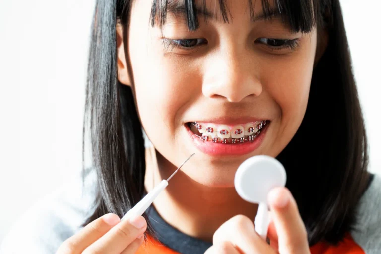 How to Clean Teeth with Braces: A Complete Guide