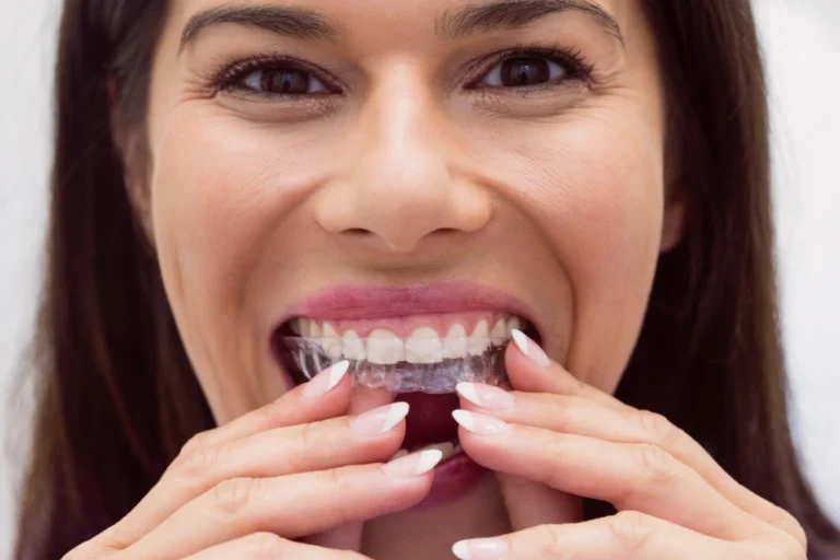 Using Invisalign Retainer After Treatment: What You Need to Know