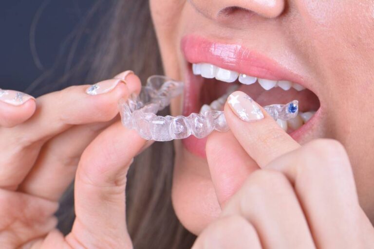 How Long is Invisalign Treatment? 