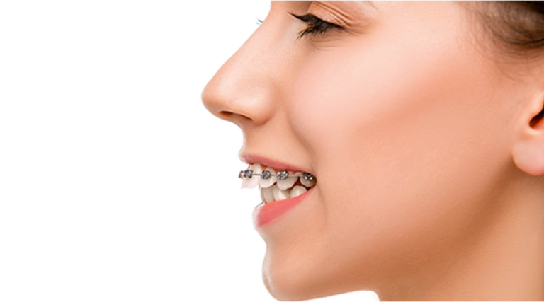 Can Braces Fix an Overbite? Explore the Facts!