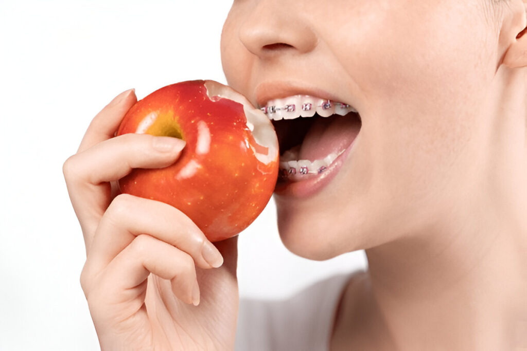 What Can I Eat With Braces