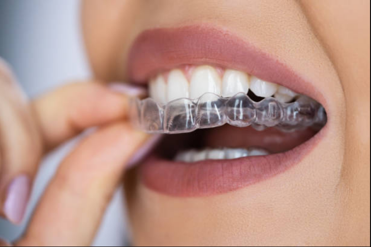 Invisalign vs. Braces Cost