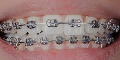 braces for adults