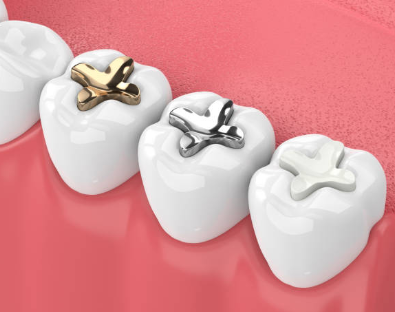 Silver Fillings