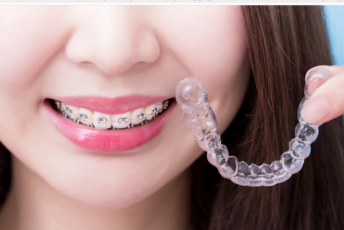 Braces