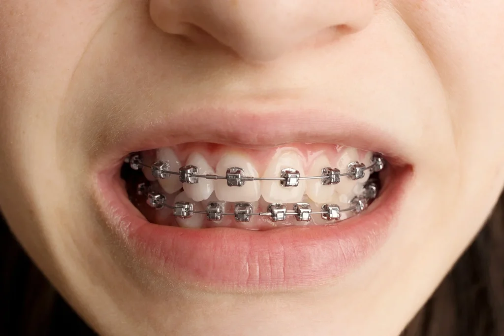 How Long Does Orthodontic Treatment Take? A Realistic Timeline!