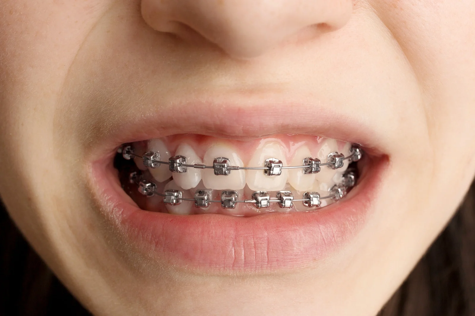 Orthodontic Treatment