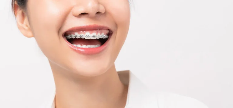 What Are the Most Affordable Braces Options in Brandon?