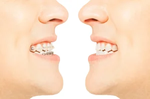 Metal Braces vs. Clear Braces