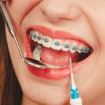 Are Metal Braces Still the Most Effective Way to Straighten Teeth in Brandon, FL?