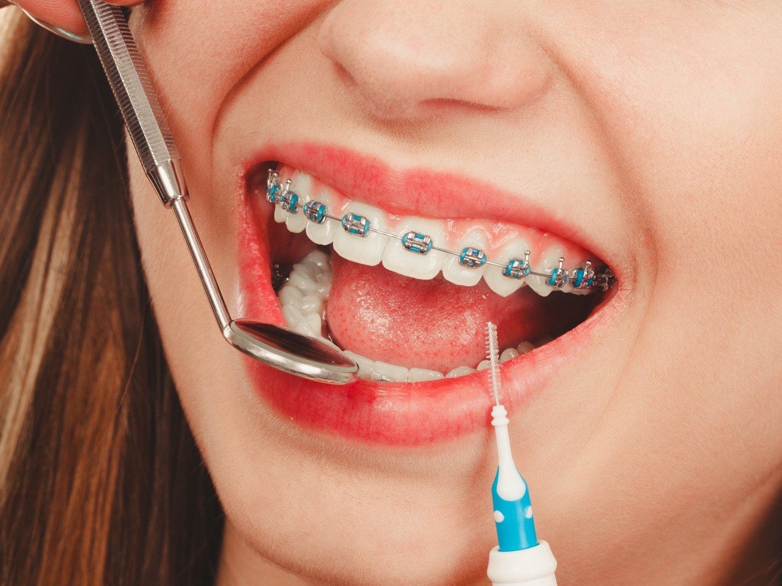 Are Metal Braces Still the Most Effective Way to Straighten Teeth in Brandon, FL?