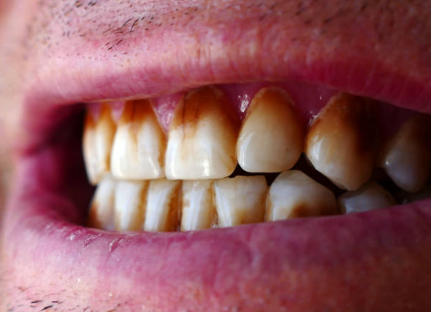 Risks of Drinking Coffee with Invisalign