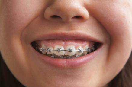 braces cost in Riverview