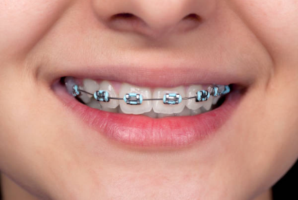 braces