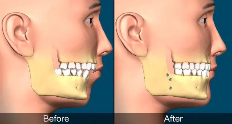 The Science Behind Proper Jaw Alignment With Braces