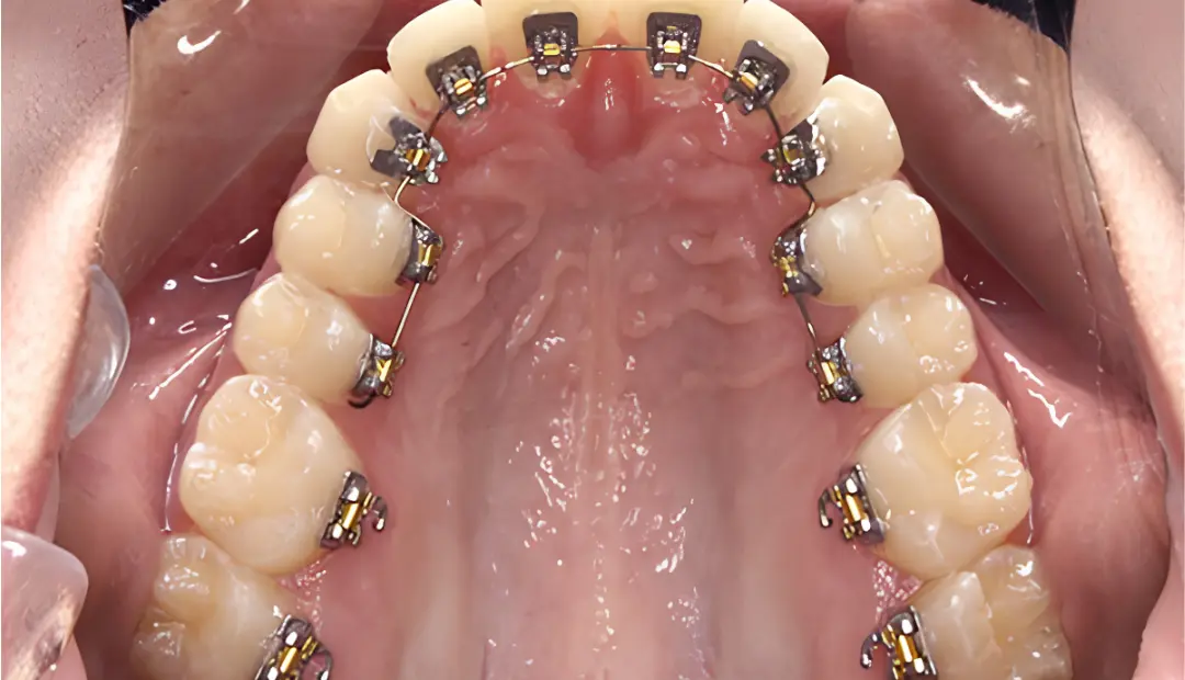 Do Braces Affect Your Speech 