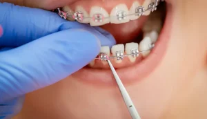 Do Braces Affect Your Speech? What to Expect and How to Adjust!