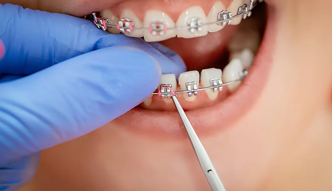 Do Braces Affect Your Speech? What to Expect and How to Adjust!