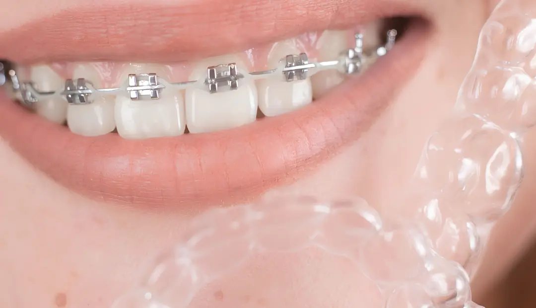 Does Insurance Cover Braces or Invisalign in Florida
