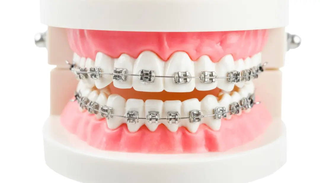 Does Insurance Cover Braces or Invisalign in Florida