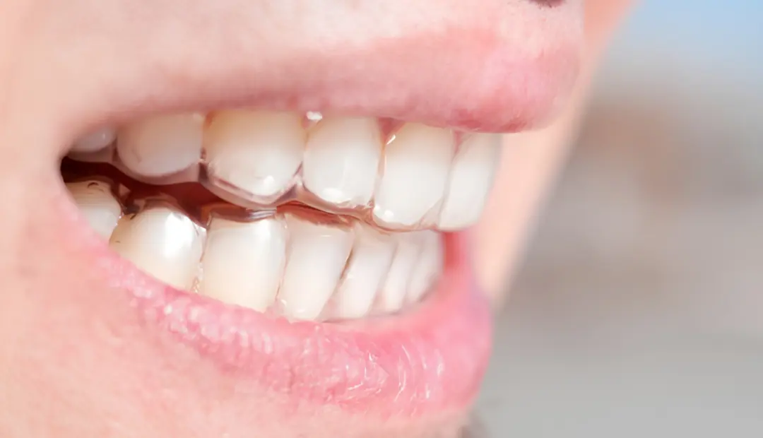 How Long Does Invisalign Take to Work 