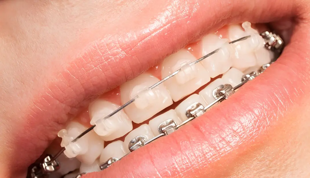 How Much Do Braces Cost in Dunedin