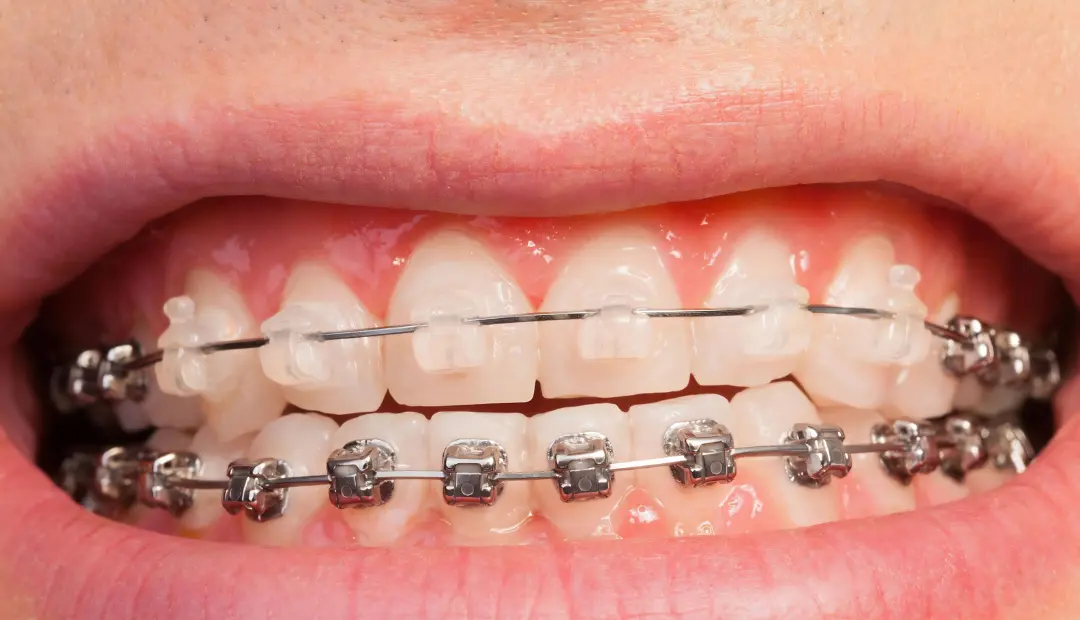 How Much Do Braces Cost in Dunedin