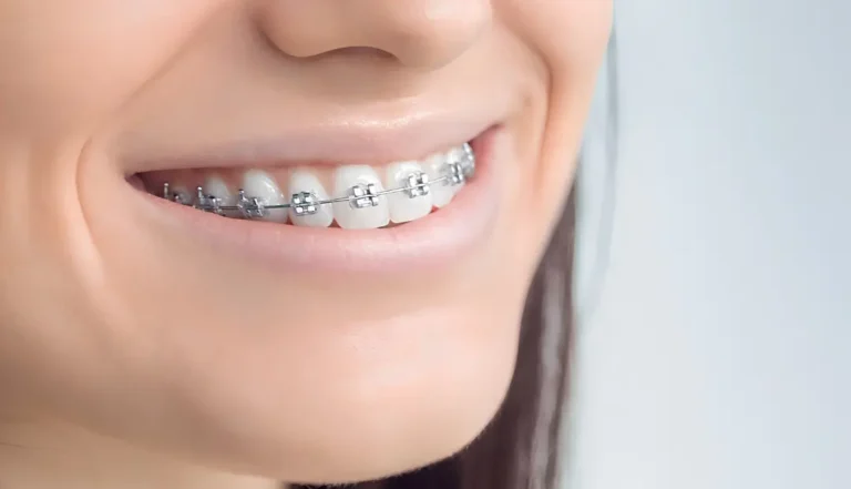 How Much Do Braces Cost in South Tampa?
