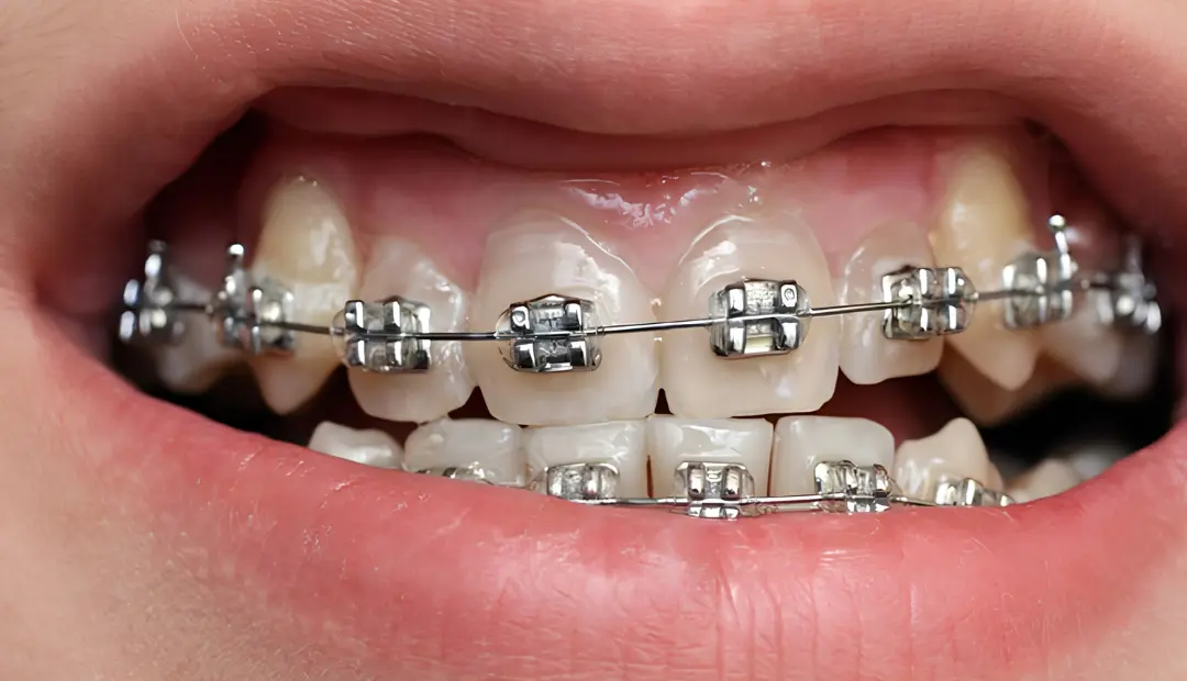 How Much Do Braces Cost in South Tampa 