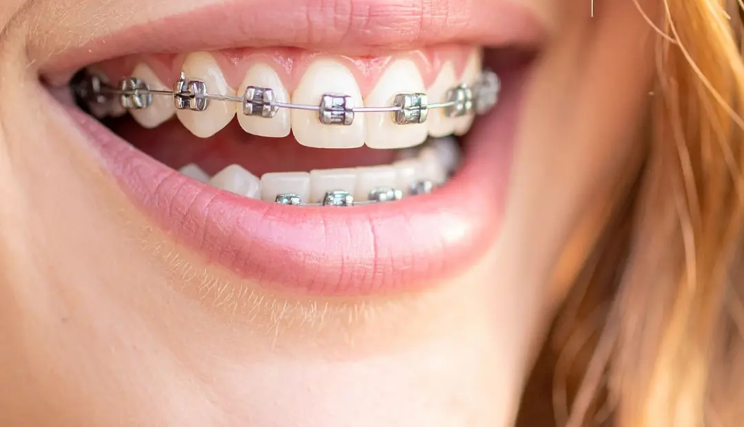 How Much Do Braces Cost in Spring Hill